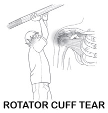 Rotator cuff injury can occur working overhead